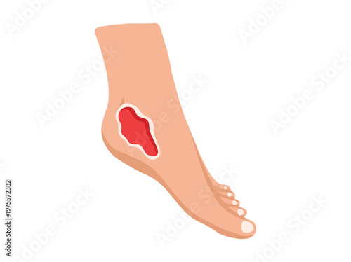 Hand Drawn Diabetic Foot Ulcers