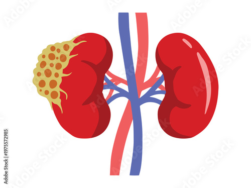 Kidney Cancer Disease Clip Art
