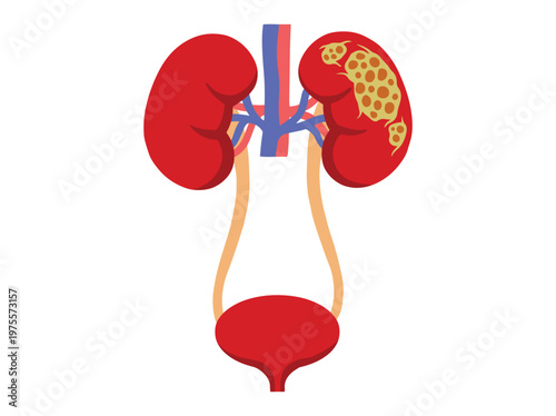 Human Kidney Cancer Disease Illustration