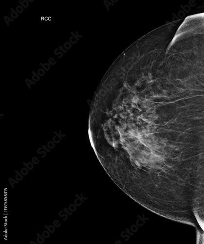 Right craniocaudal (RCC) view mammogram displaying benign fibroglandular tissue. Excellent for targeted breast cancer screening and diagnostic medical imaging.