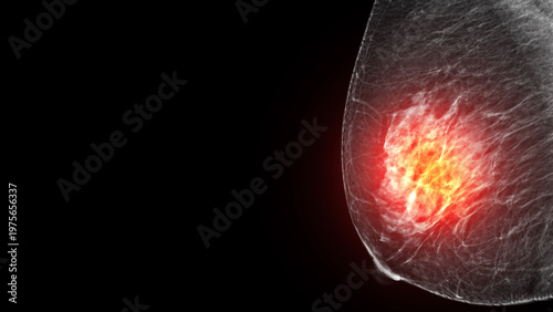 Conceptual mammogram with a glowing red highlight indicating a breast tumor, cancer, or severe inflammation. Highly effective for oncology and breast cancer awareness campaigns.