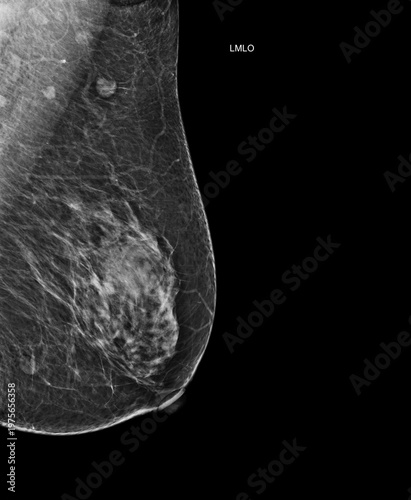  Left mediolateral oblique (LMLO) mammogram image displaying benign findings (BI-RADS 2). Ideal for clinical diagnostics, oncology, and breast cancer awareness.