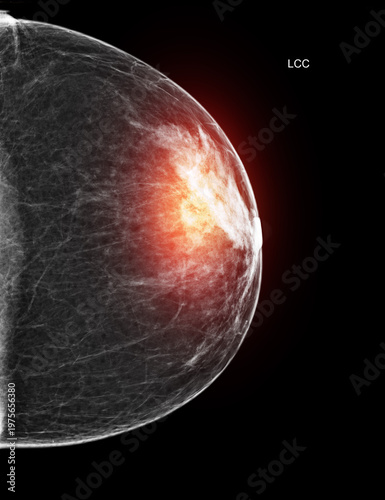 Unilateral mediolateral oblique (MLO) mammogram of the right breast showing benign findings. Medical scan for cancer screening and radiology concepts.