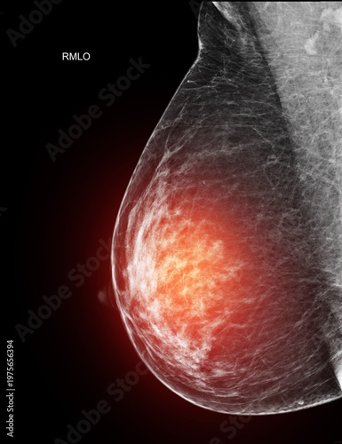 Unilateral mediolateral oblique (MLO) mammogram of the left breast showing benign findings (BI-RADS 2). Medical scan for cancer screening and women's wellness.