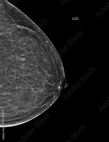 Left craniocaudal (LCC) mammogram displaying benign findings with small cysts. Perfect medical imaging for oncology, early detection, and routine health checkups.
