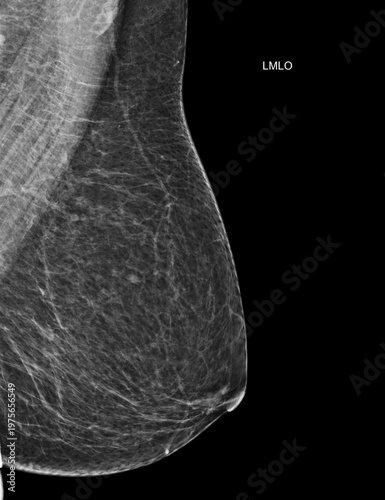 Left mediolateral oblique (LMLO) mammogram image showing a healthy screening result (BI-RADS 2). Ideal for women's wellness and breast cancer prevention campaigns.