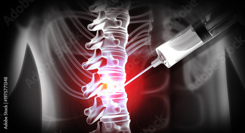Medical 3D illustration of an anatomical human spine showing disc degeneration and a targeted epidural steroid injection for pain relief.