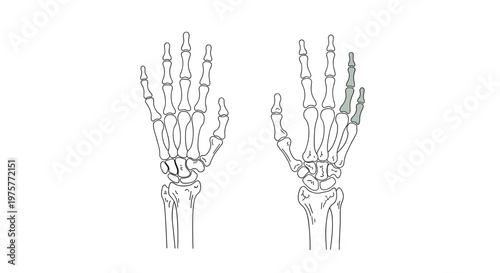 A comparative anatomical illustration displays two human hands with specific finger bones highlighted in a muted green color for medical or educational study.