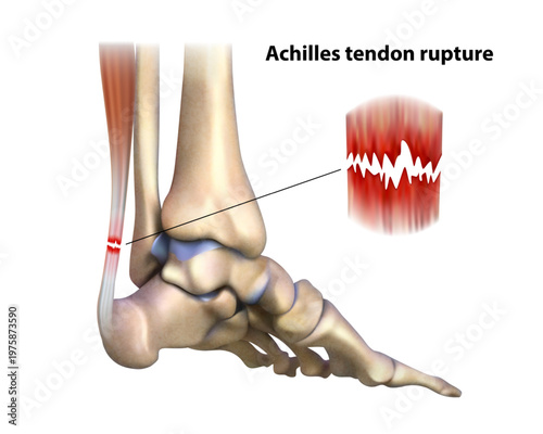 Tendon rupture. Isolated vector illustration