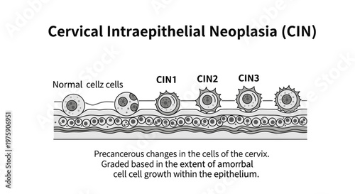 Medical diagram of Cervical Intraepithelial Neoplasia (CIN) showing stages from normal cells to CIN3.