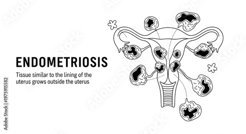 Medical illustration of Endometriosis showing tissue growing outside the uterus with explanatory text.