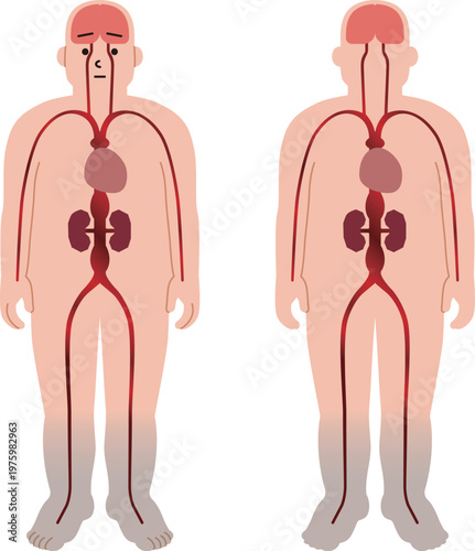 血管障害などによる疾患。動脈瘤や心臓、腎臓の病気のイラスト。
