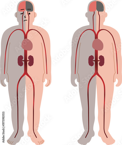 血管障害などによる疾患。半身麻痺や脳、心臓、腎臓の病気のイラスト。