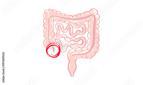 Inflamed appendix scetch