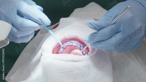 Professional dentist applying blue plaque disclosing agent to patient teeth using microbrush. Diagnostic procedure for identifying bacterial biofilm and dental stone in stomatology clinic