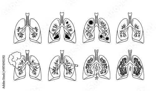 Human lungs illustration set – healthy and diseased states in black and white