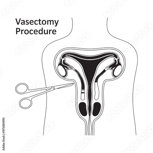Medical illustration depicting a vasectomy procedure on the male reproductive system