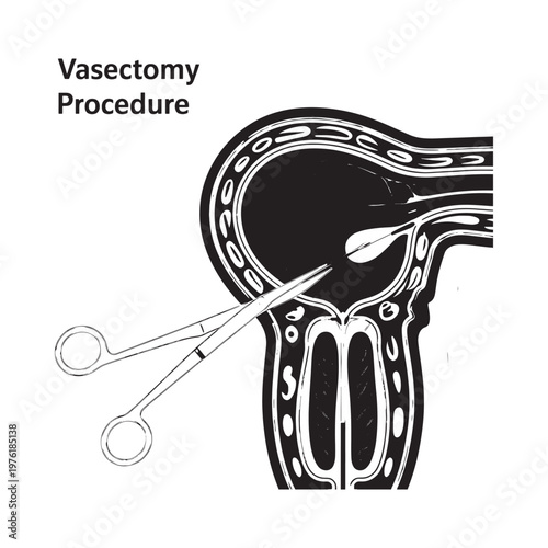 Diagram illustrating a vasectomy procedure on male reproductive anatomy