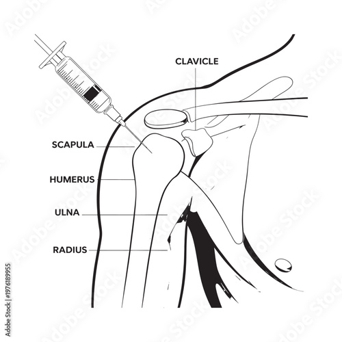 Anatomy of the shoulder joint with a syringe indicating an injection site