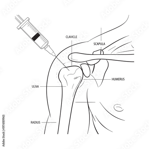 Anatomical illustration depicting a shoulder injection and labeled skeletal structure