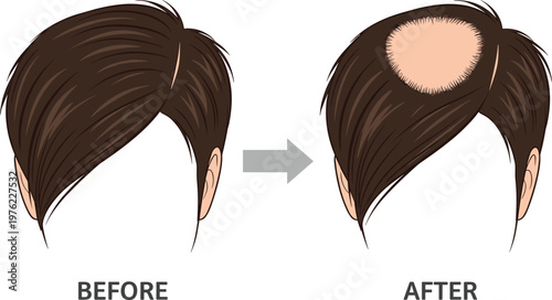 Male Hair Loss Before and After Comparison Vector Illustration Showing Bald Spot Progression and Alopecia Treatment Concept Design
