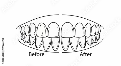 Line art comparison of teeth showing cracks before and smooth after treatment