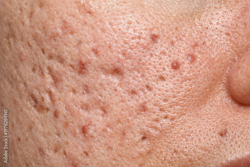 Frustrating macro detail of human face with severe acne problem. skin shows deep pimple scar, enlarged pore, and uneven texture, concern for dermatology care