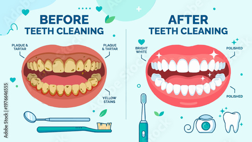 Before and after comparison of teeth cleaning showing improved oral hygiene.