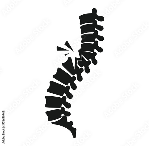 Spinal column with one vertebra cracked and broken  medical concept