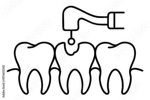 Dental Caries Treatment with Drill Tooth Preparation and Decay Removal for Filling Restoration