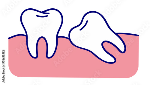 Tilted Tooth and Malocclusion, Incorrect Tooth Angle in Gum Dental Problem