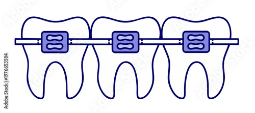 Orthodontic Brackets and Wire Close Up, Dental Braces System for Tooth Alignment