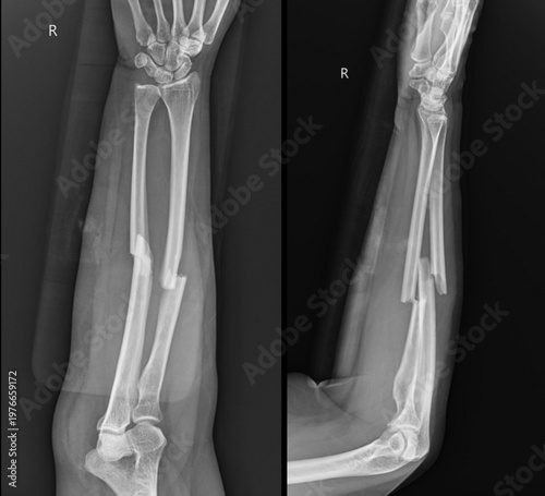 Medical X-ray of Forearm Showing Both Bone Fracture of Radius and Ulna with Displacement.
