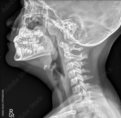 Lateral Neck X-ray Showing Adenoid Hypertrophy and Nasopharyngeal Airway Obstruction in Pediatric Patient.