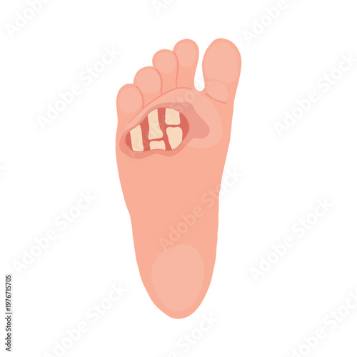 Diabetic Foot Ulcer Stages Medical Illustration