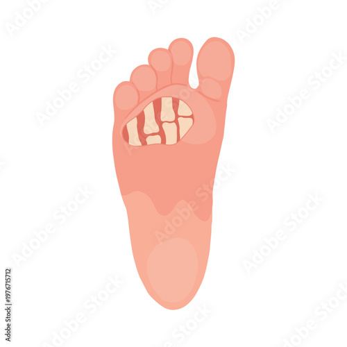 Diabetic Foot Ulcer Stages Medical Illustration