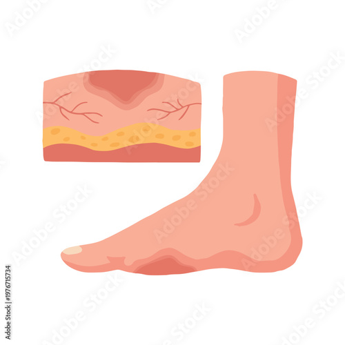 Diabetic Foot Ulcer Stages Medical Illustration