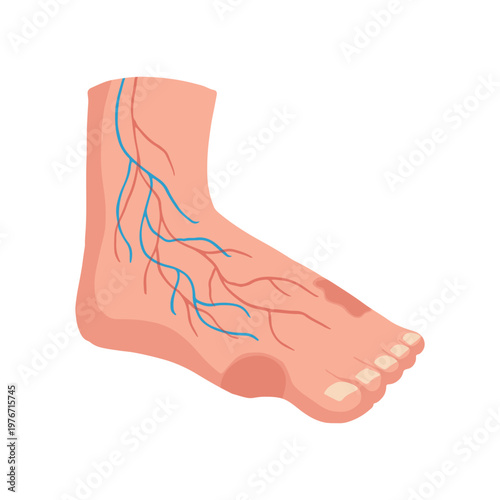 Diabetic Foot Ulcer Stages Medical Illustration