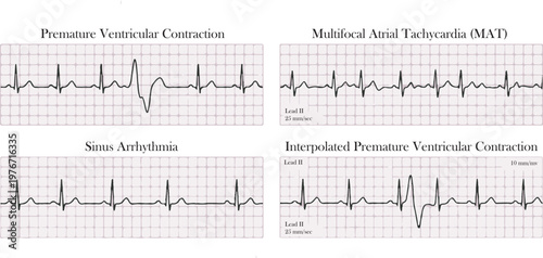 Electrocardiogram show Premature Atrial Contraction (PAC) pattern ,Heart beat ,ECG ,EKG interpretation ,Vital sign ,Life line ,Medical healthcare symbol