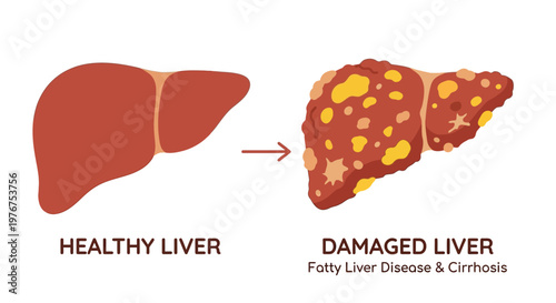 Comparison of a healthy liver versus one affected by fatty liver disease