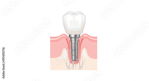 Detailed medical cross-section showing a single dental implant securely anchored within the gum tissue and jawbone under a pristine white clinical light.