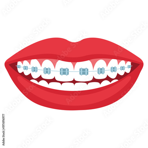 Straight Smile: An up-close illustration showcasing a set of teeth adorned with orthodontic braces, held within a pair of vibrant red lips, embodying the journey to a straighter, more confident smile.