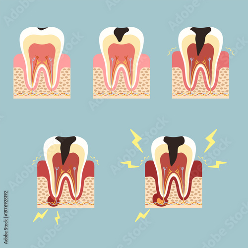 Cross section diagram of tooth structure with alveolar bone and gum tissue illustration for dental education
