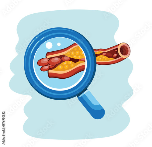 Blocked Artery with Severe Cholesterol Plaque with Magnifying Glass Illustration
