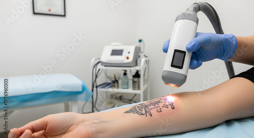 Laser machine being used on a person arm for tattoo erasing procedure