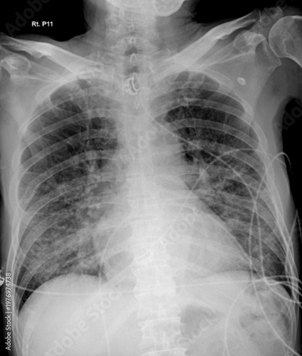 Medical Chest X-ray Showing Pulmonary Infection and Pneumonia Infiltrates in Human Lungs.