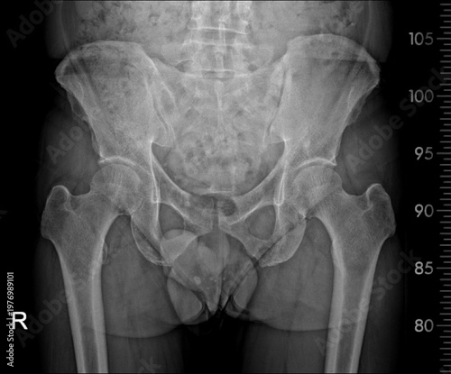 Full-Length Lower Limb X-ray Scanogram for Alignment and Leg Length Study.
