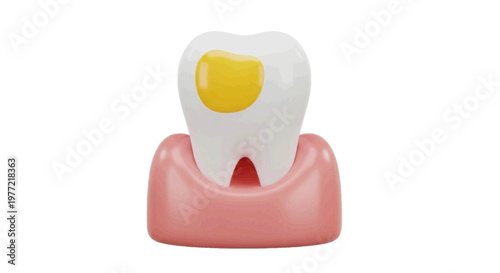 Vector illustration of 3d illustration of a tooth with a yellow filling in the gum on a transparent background