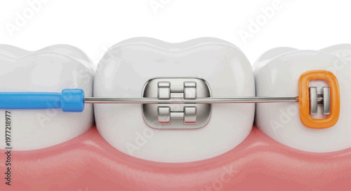 Vector illustration of closeup of dental braces on teeth on a transparent background