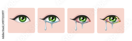 Allergic and bacterial conjunctivitis. Vector 3D illustration.